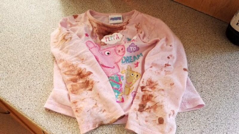 PIC FROM CATERS NEWS - (PICTURED: Sienna Duffields bloody clothes..) -An adorable toddler who was being eaten alive by a ravaging skin infection has finally recovered. Sienna Duffield, who is now three years old, was diagnosed with herpes earlier in the year - a contagious virus, which caused blisters to spread across her face. The toddler kissed a family member in October 2015 which caused the severe infection. Her mother, Savina French-Bell, 21, had to wash Siennas bed sheets daily and constantly throw out clothes because of daily blood stains from Siennas sores. The painful blisters were extremely itchy and caused Siennas sensitive skin to be covered in blood stains and pus. Sienna was admitted to hospital on her second birthday in October 2015 where she was placed on an iv drip because she had stopped eating. Savina then sought advice for creams and antibiotics to prevent Siennas condition from getting even worse. The young mother is now sharing their story to help other parents battling the same condition. SEE CATERS COPY.