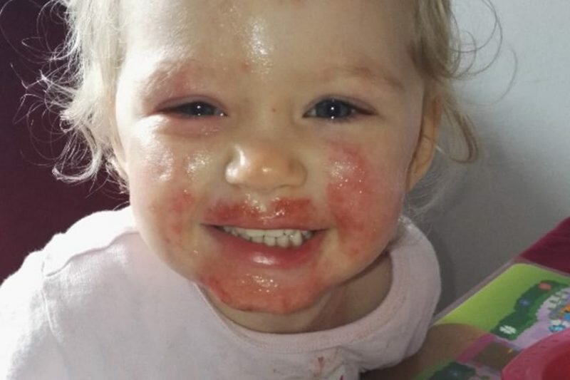 PIC FROM CATERS NEWS - (PICTURED: Sienna Duffield when her condition was healing.) -An adorable toddler who was being eaten alive by a ravaging skin infection has finally recovered. Sienna Duffield, who is now three years old, was diagnosed with herpes earlier in the year - a contagious virus, which caused blisters to spread across her face. The toddler kissed a family member in October 2015 which caused the severe infection. Her mother, Savina French-Bell, 21, had to wash Siennas bed sheets daily and constantly throw out clothes because of daily blood stains from Siennas sores. The painful blisters were extremely itchy and caused Siennas sensitive skin to be covered in blood stains and pus. Sienna was admitted to hospital on her second birthday in October 2015 where she was placed on an iv drip because she had stopped eating. Savina then sought advice for creams and antibiotics to prevent Siennas condition from getting even worse. The young mother is now sharing their story to help other parents battling the same condition. SEE CATERS COPY.