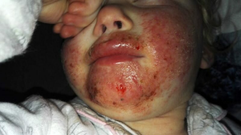 PIC FROM CATERS NEWS - (PICTURED: Sienna Duffield when her condition was at its worse.) -An adorable toddler who was being eaten alive by a ravaging skin infection has finally recovered. Sienna Duffield, who is now three years old, was diagnosed with herpes earlier in the year - a contagious virus, which caused blisters to spread across her face. The toddler kissed a family member in October 2015 which caused the severe infection. Her mother, Savina French-Bell, 21, had to wash Siennas bed sheets daily and constantly throw out clothes because of daily blood stains from Siennas sores. The painful blisters were extremely itchy and caused Siennas sensitive skin to be covered in blood stains and pus. Sienna was admitted to hospital on her second birthday in October 2015 where she was placed on an iv drip because she had stopped eating. Savina then sought advice for creams and antibiotics to prevent Siennas condition from getting even worse. The young mother is now sharing their story to help other parents battling the same condition. SEE CATERS COPY.